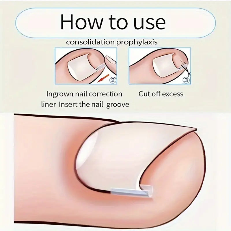 Ingrown Toenail Corrector Strips